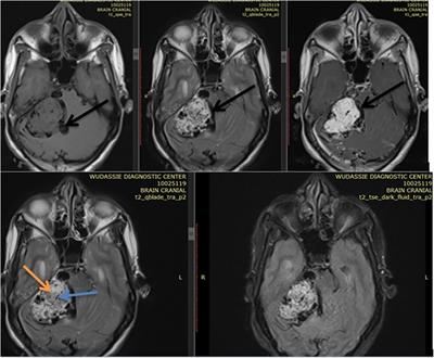 Diffuse subarachnoid hemorrhage following ventriculo-peritoneal shunt insertion for acute obstructive hydrocephalus from large glomus jugulare tumor: case report